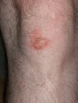 Kleine Schramme am Knie